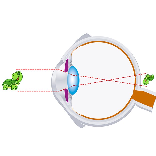 oeil hypermétrope